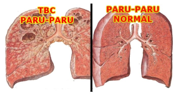 Foto paru-paru sehat dan tidak sehat. Indonesia yang pada tahun 2022 berhasil menemukan 74% kasus TBC f, RSUD Banjar Kota