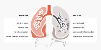 Jelang Peringatan Hari Tuberkulosis Sedunia 2025: Kemenkes Luncurkan Kampanye GIATKAN untuk Akhiri TBC di Indonesia foto, ilustrasi